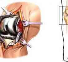 Consecințele leziunilor articulației genunchiului. Proteze și reabilitare