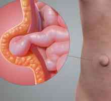 Hernia postoperatorie pe abdomen: consecințe și tratament