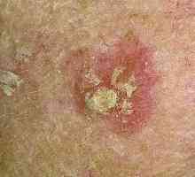 La ce boli patul pe piele este scalabil?