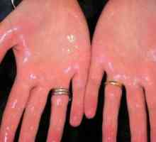 Motivele pentru apariția transpirației pe mâini