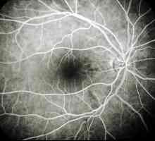 Cauze, simptome și tratamentul angiopatiei retiniene