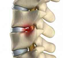 Cauze, simptome și tratamentul fracturii de compresie a coloanei vertebrale