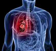 Cancerul pulmonar scuamos: descriere, cauze, diagnostice și caracteristici de tratament