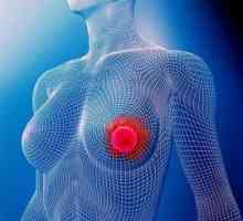 Рак молочной железы, 2а стадия: прогноз. Рак груди 2а стадии лечится?