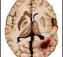 Brain cancer: cauze, simptome și diagnostic