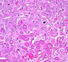 Рак плоскоклеточный шейки матки: прогноз, лечение