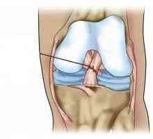 Ruptura ligamentului articulației genunchiului: de ce se întâmplă și cum să o eliminați?