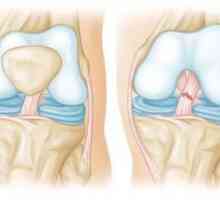 Ruptura ligamentelor articulației genunchiului