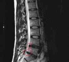 Retrolizarea L5 vertebră - ce este? Boli ale coloanei vertebrale cu deplasarea vertebrelor