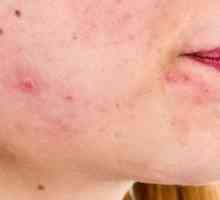 Dermatita seboreică pe față: tratament, cauze și prevenire