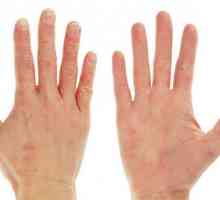 Шелушится кожа на руках: причины и лечение