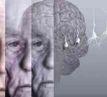 Sindrom de demență sau demență