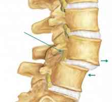 Spondiloza coloanei vertebrale cervicale: cauze, simptome și metode de tratament