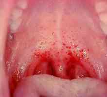 Infecția streptococică la copil pe piele