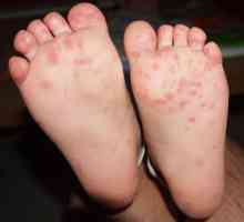 Erupția pe picioarele unui copil: diagnostic, tratament, prevenire