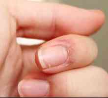 Piele fisurată pe degetele din apropierea unghiilor: cauzele și tratamentul. Cracked pielea de pe…