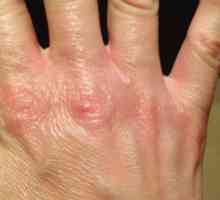 Pielea crăpată pe degete: cauze, tratament