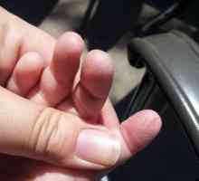La copil, pielea de pe degetele degetelor se va înțelege, ce să facă sau să facă?