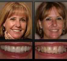 Întoarceți-vă un zâmbet frumos va ajuta protezele permanente ale dinților