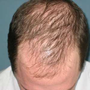 Alopecia androgena la femei și bărbați: cauze, tratament și consecințe