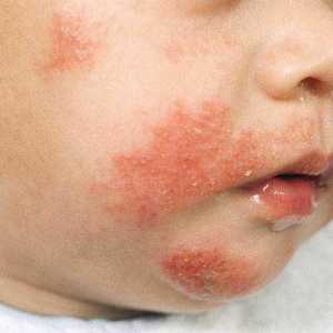 Dermatita atopica la un copil: tratament si simptome