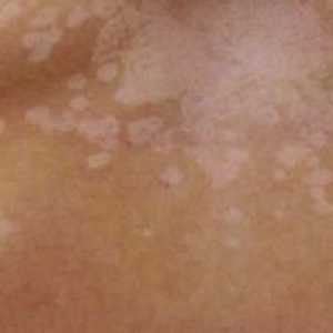 Pete albe pe piele după arsuri solare: tratament, fotografie