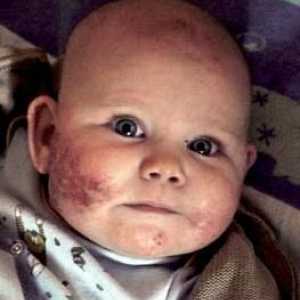 Ce este dermatita atopică la copii?
