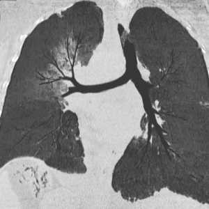 Ce este sarcomul pulmonar? Pot să scap de asta?