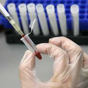 Ce este ESR într-un test de sânge? Care este abaterea de la normă?