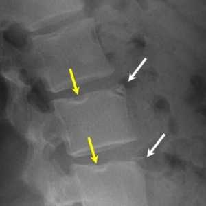 Hernia coloanei vertebrale: cauze, simptome și metode de tratament