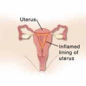 Endometrita cronică: simptome și tratament. Remedii populare în tratamentul endometritelor