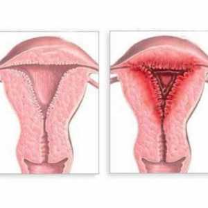 Endometrita: ce este? Cauzele, simptomele și tratamentul bolilor