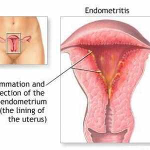 Endometrita uterului - ce este? Simptomele endometritelor la femei. Ginecologie - endometrita