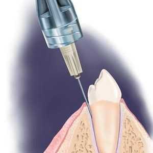 Cum acționează Ultracaine în stomatologie?