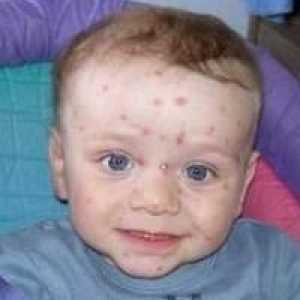 Cum sa recunoasca primele semne de varicela la un copil