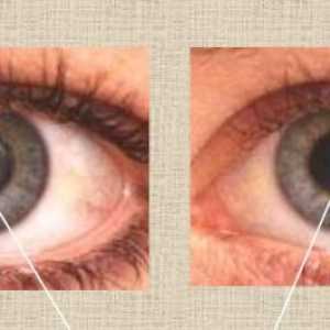 Care sunt principalele cauze ale cataractei?