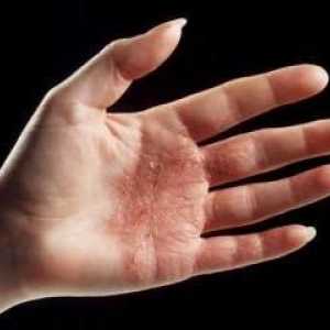 Dermatita dermatita pe maini: tratament