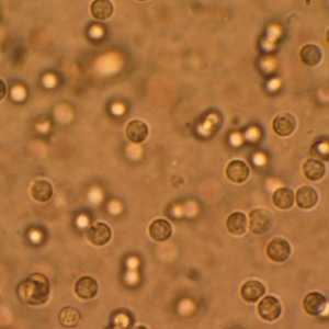 Leucocitele din urină sunt ridicate: cauze și consecințe