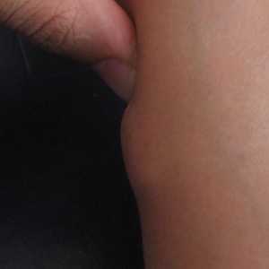 Lipom (adipos) pe picioare: cauze, simptome și tratament