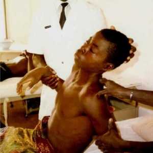 Meningita: simptomele și consecințele bolii, care este mai frecventă la copii și adulți