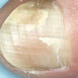 Micoza din unghii: cum să evitați și cum să tratați