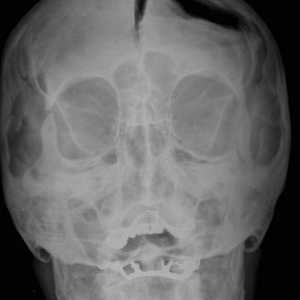 Cât de periculoase sunt fracturile de bază ale craniului