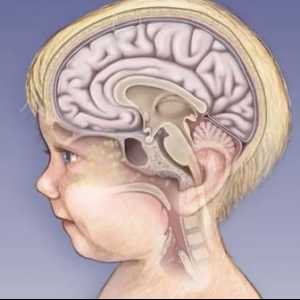 Cât de grave sunt efectele meningitei la copii?