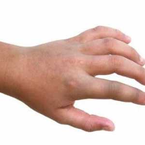 Unele informații despre ce este o mână fracturată