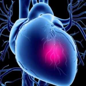 Îngrijire de urgență pentru șoc cardiogen: un algoritm de acțiune. Brigada de urgență pentru…