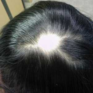 Alopecia la femei: cauze, tratament. Baldness pentru femei