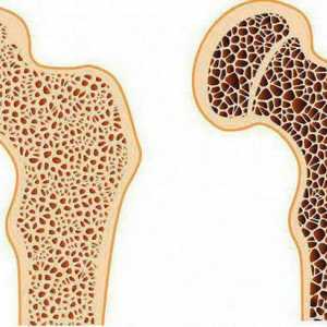 Osteoporoza articulației șoldului: simptome și tratament, diagnostic