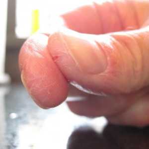 Degetele de pe mâini crack: cauze și tratament