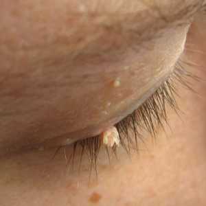 Papilloma pe ochi. Cauze de papilom pe pleoapă și metode de îndepărtare