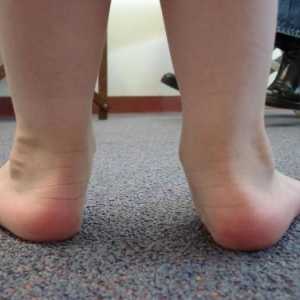 Ploskovolgusnye picioare la copil. Metode de tratament